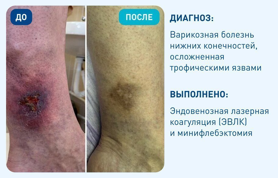 Варикозная болезнь нижних конечностей