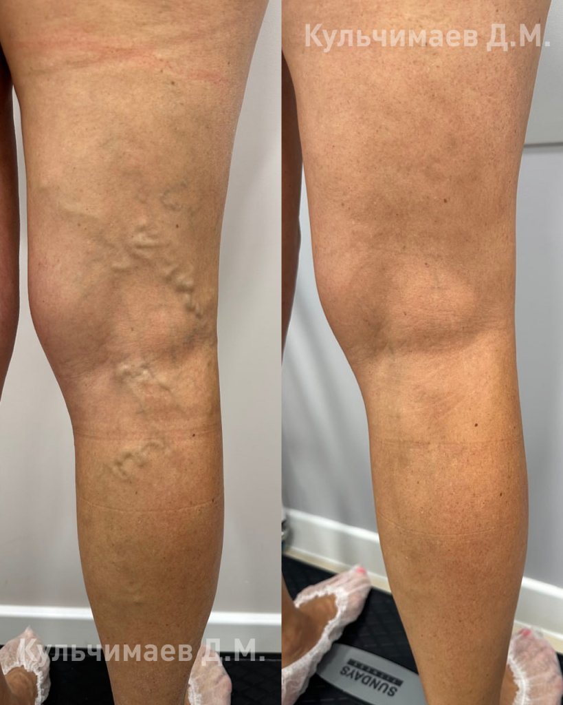 Варикозная болезнь нижних конечностей