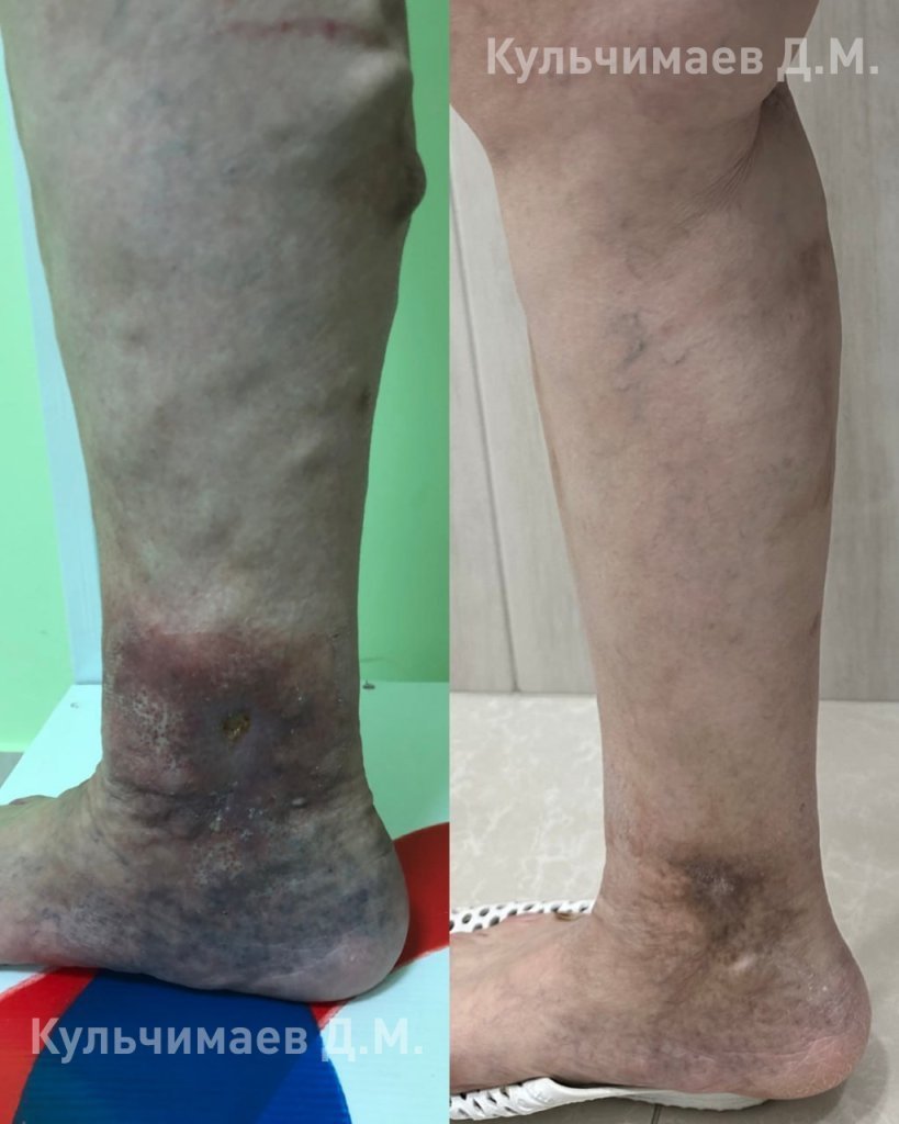 Варикозная болезнь нижних конечностей