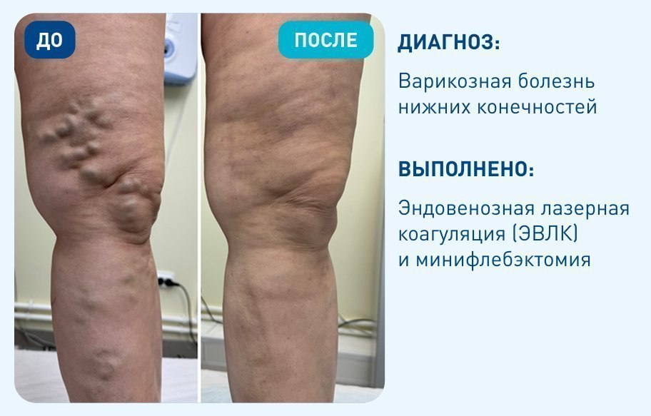 Варикозная болезнь нижних конечностей Варикозная болезнь нижних конечностей