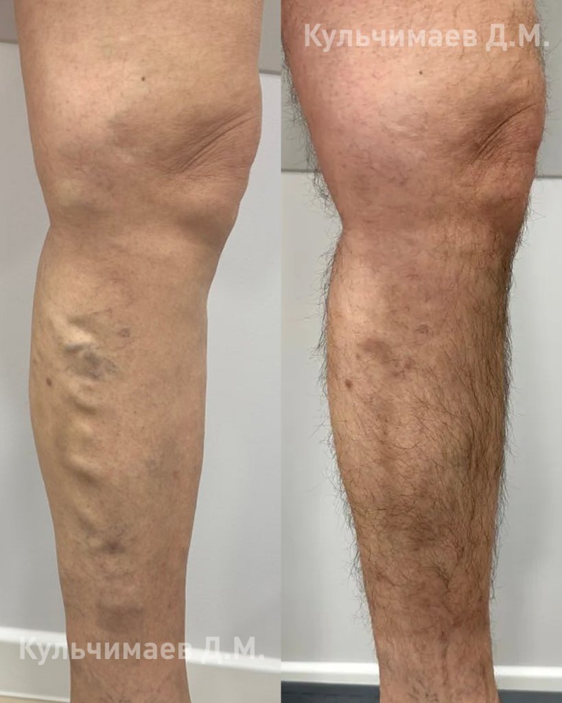 Варикозная болезнь нижних конечностей