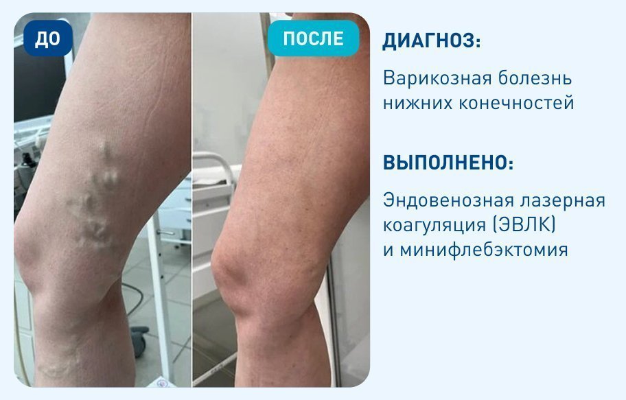 Варикозная болезнь нижних конечностей Варикозная болезнь нижних конечностей