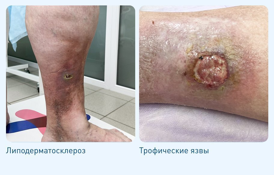 Флебологические заболевания Флебологические заболевания