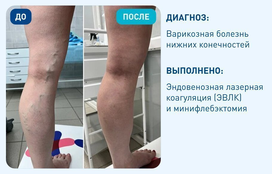 Варикозная болезнь нижних конечностей Варикозная болезнь нижних конечностей