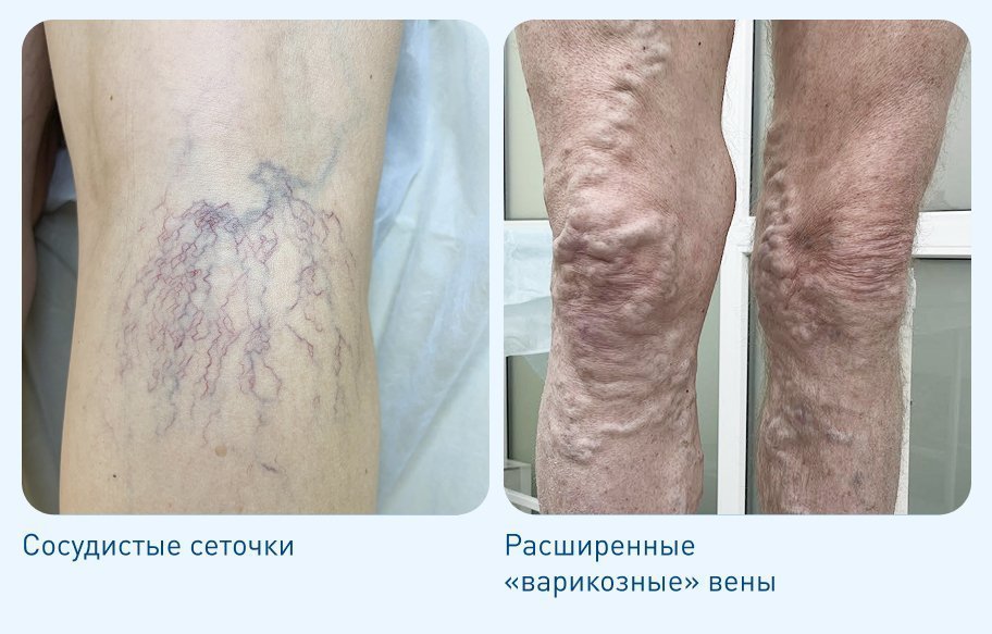 Флебологические заболевания Флебологические заболевания