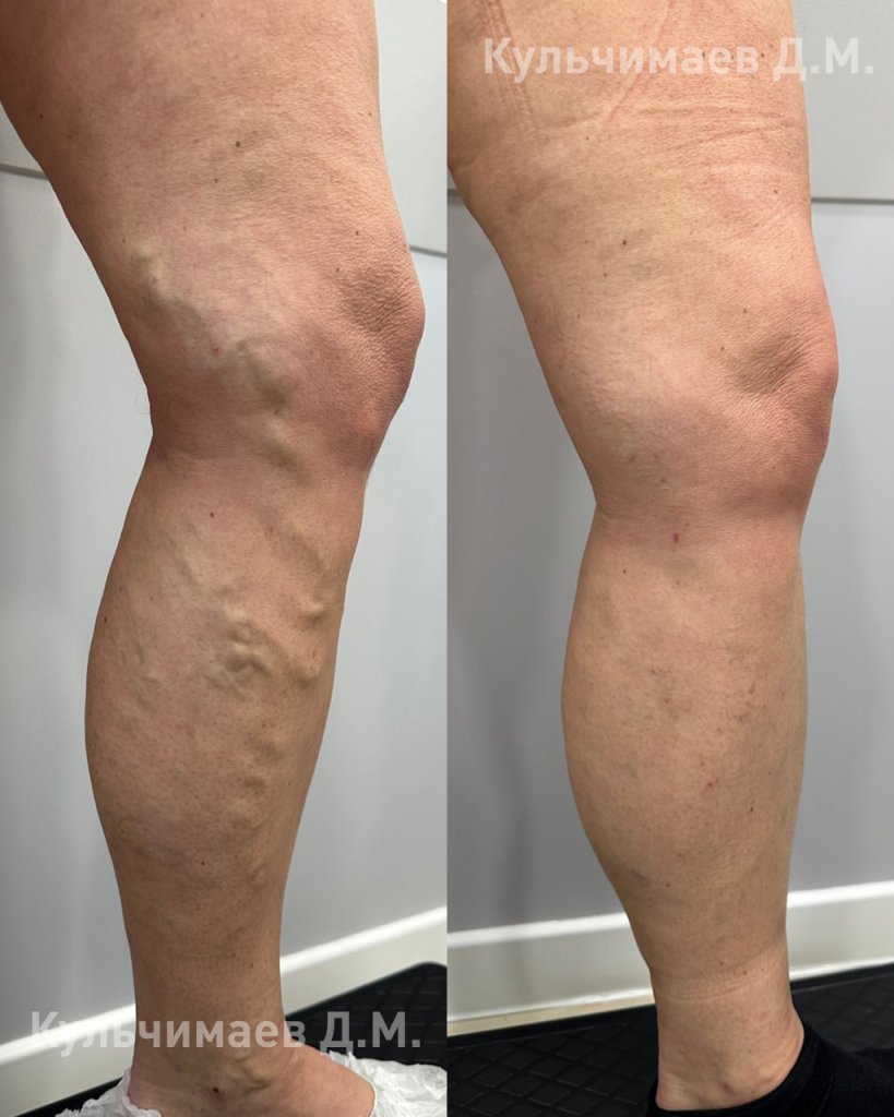 Варикозная болезнь нижних конечностей