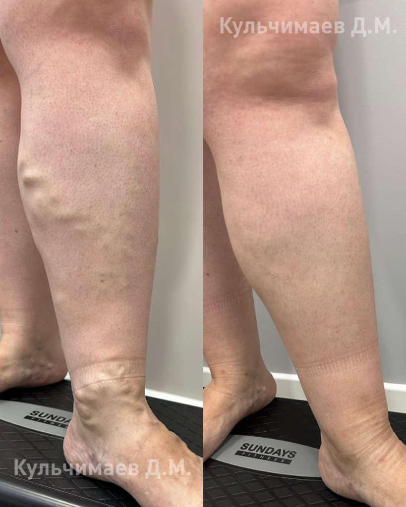 Варикозная болезнь нижних конечностей