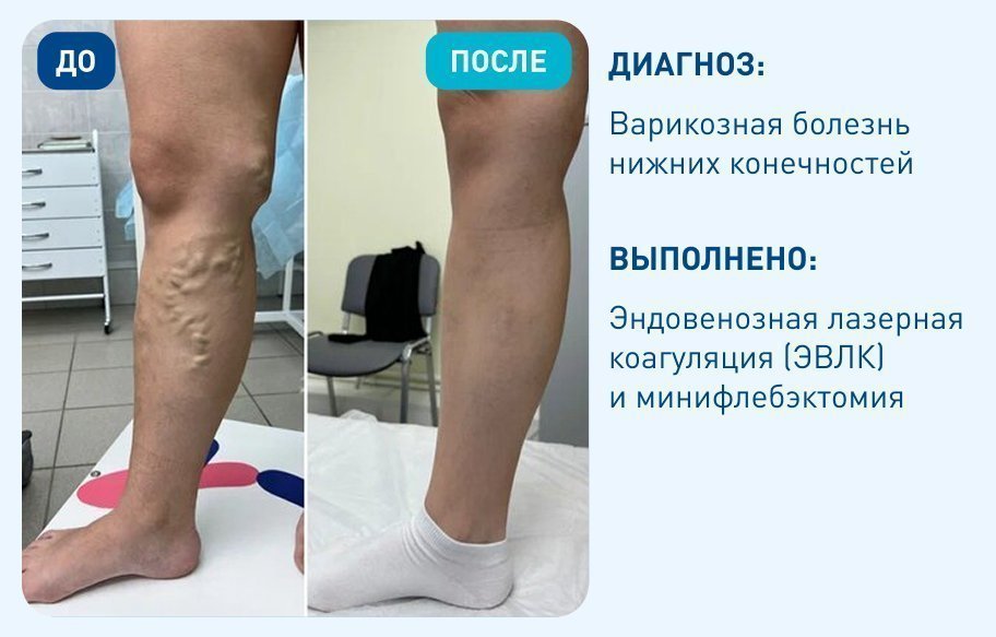 Варикозная болезнь нижних конечностей Варикозная болезнь нижних конечностей