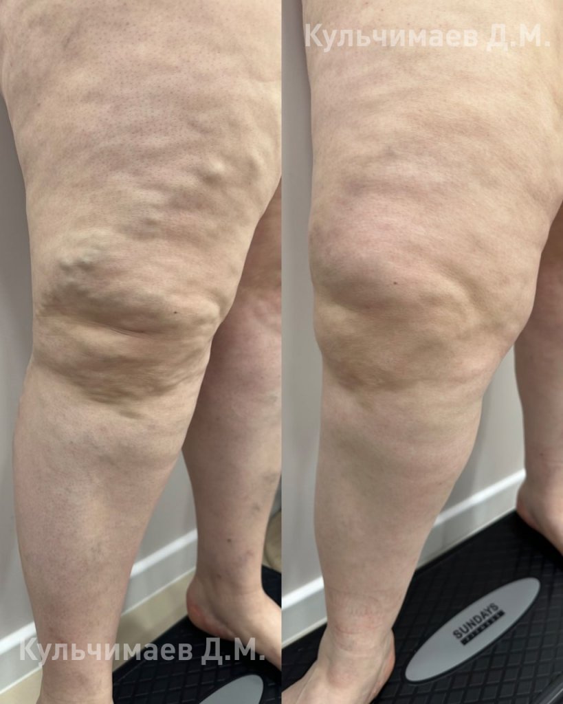 Варикозная болезнь нижних конечностей