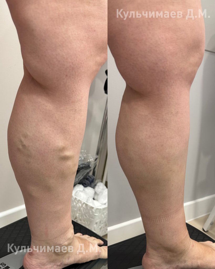 Варикозная болезнь нижних конечностей