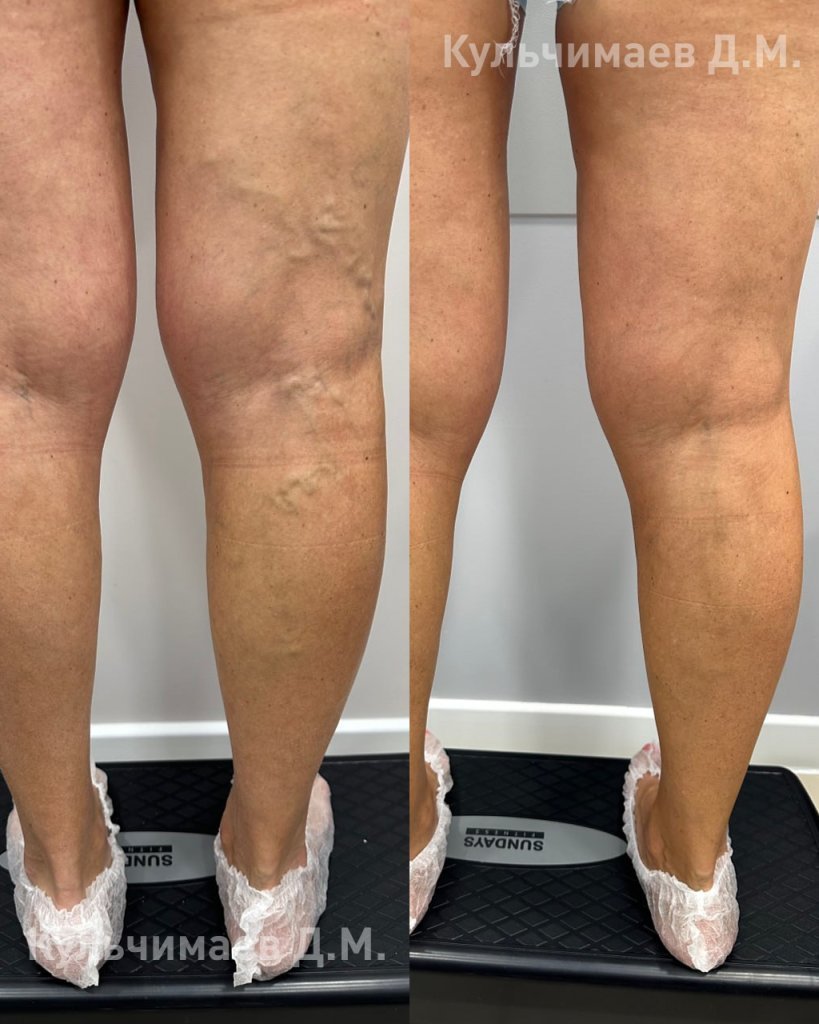 Варикозная болезнь нижних конечностей